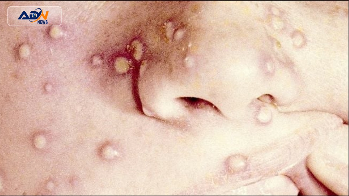 Monkeypox cases in Karachi